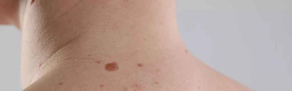 Dermatologie Oncologică Derm Med Clinic Galati